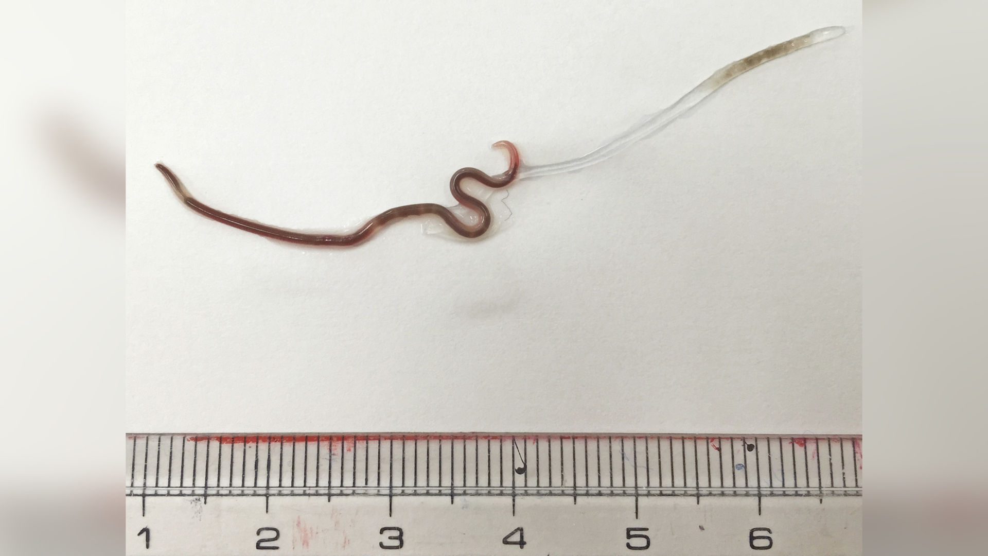 Doctors remove live worm from woman's tonsil